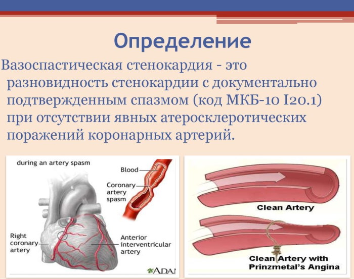 Вазоспастическая стенокардия. Клинические рекомендации, лечение