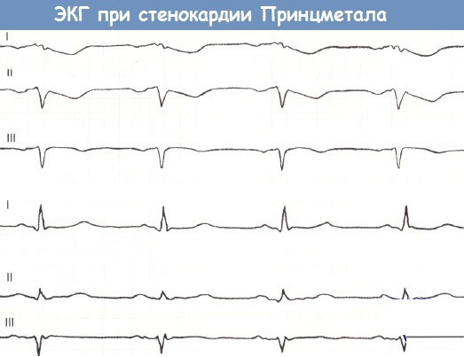 Вазоспастическая стенокардия. Клинические рекомендации, лечение