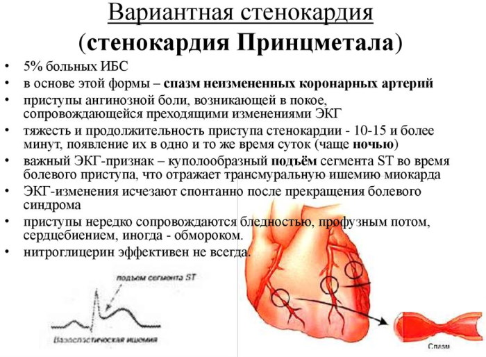 Вазоспастическая стенокардия. Клинические рекомендации, лечение