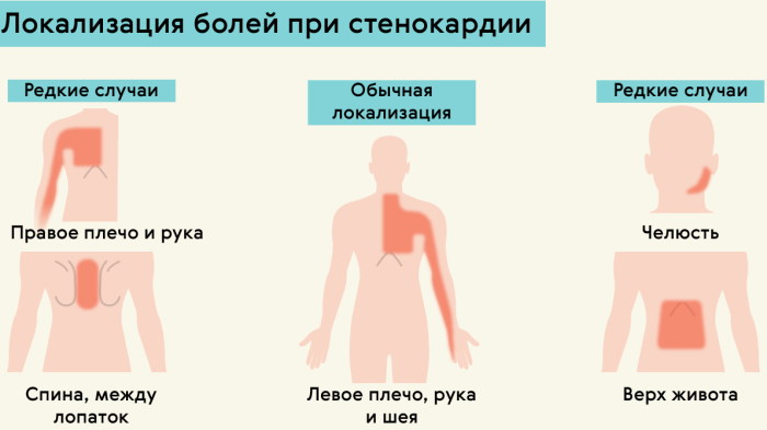 Вазоспастическая стенокардия. Клинические рекомендации, лечение