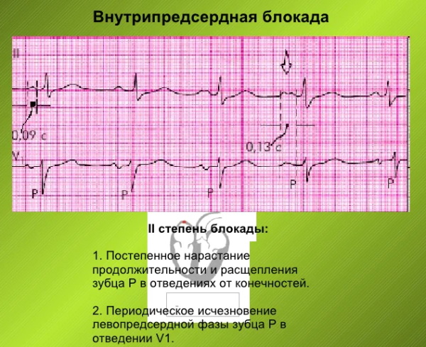 Ав блокада 3 степени на экг картинки