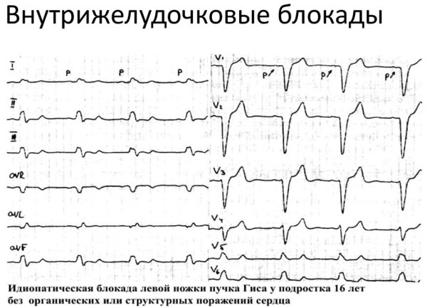 Ав блокады на экг картинки