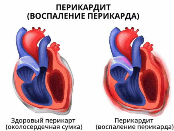 Жидкость в сердце (перикарде). Причины, последствия, лечение