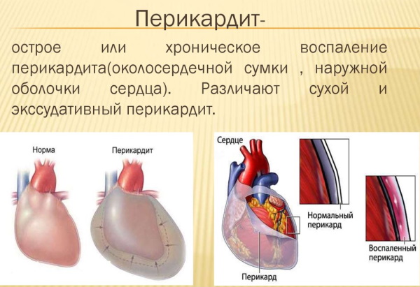 Жидкость в сердце (перикарде). Причины, последствия, лечение