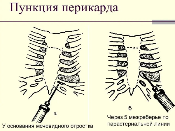 Жидкость в сердце (перикарде). Причины, последствия, лечение