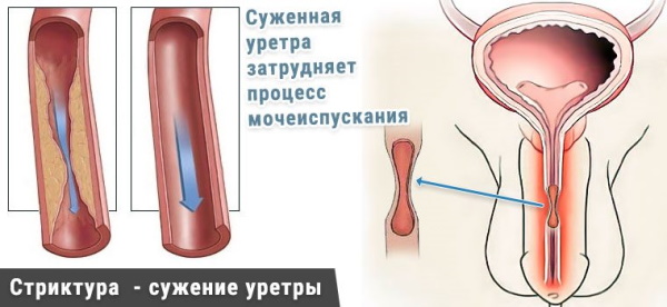 Аллергический уретрит. Симптомы и лечение у мужчин, женщин