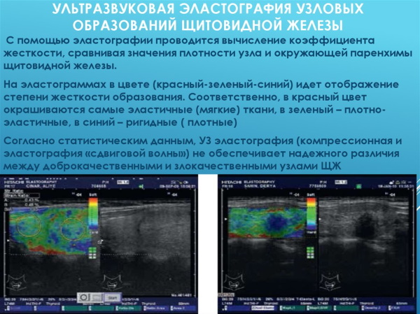 Эластография щитовидной железы. Что это такое, УЗИ, отзывы
