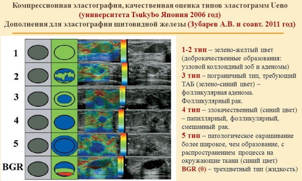 Эластография щитовидной железы. Что это такое, УЗИ, отзывы