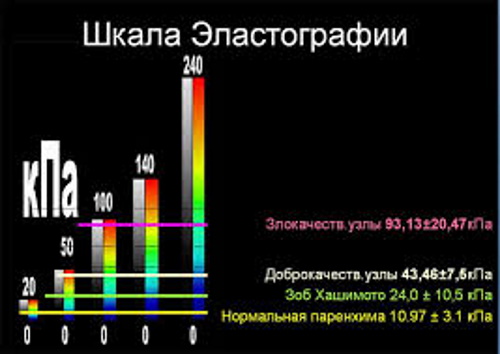 Эластография щитовидной железы. Что это такое, УЗИ, отзывы