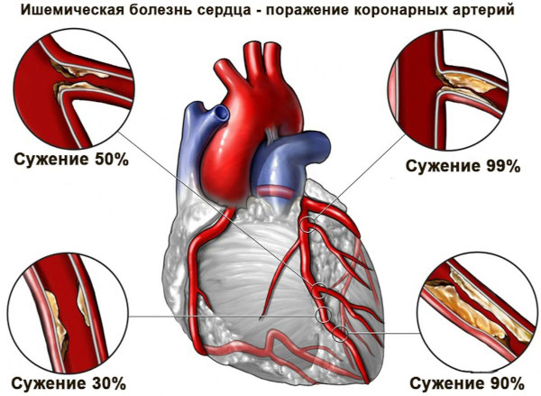 Энап и Эналаприл. В чем разница, что лучше, отзывы