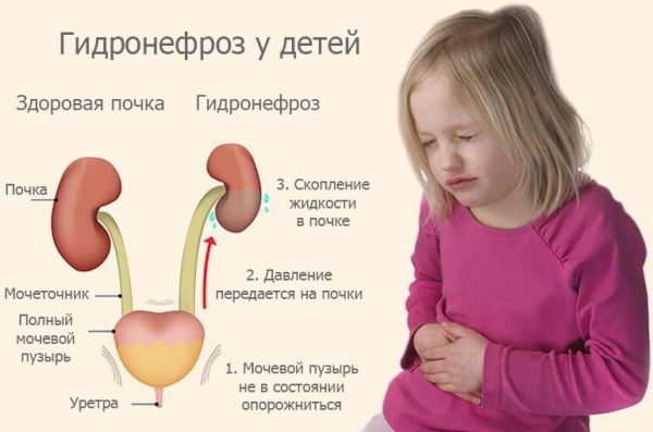 Гидронефроз почек у детей. Лечение, степени