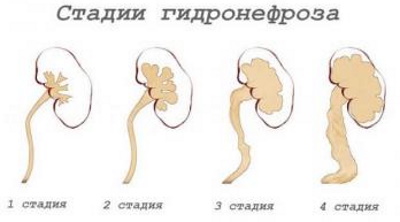 Гидронефроз почек у детей. Лечение, степени