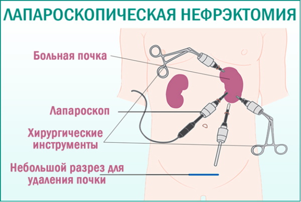 Гидронефроз почек у детей. Лечение, степени