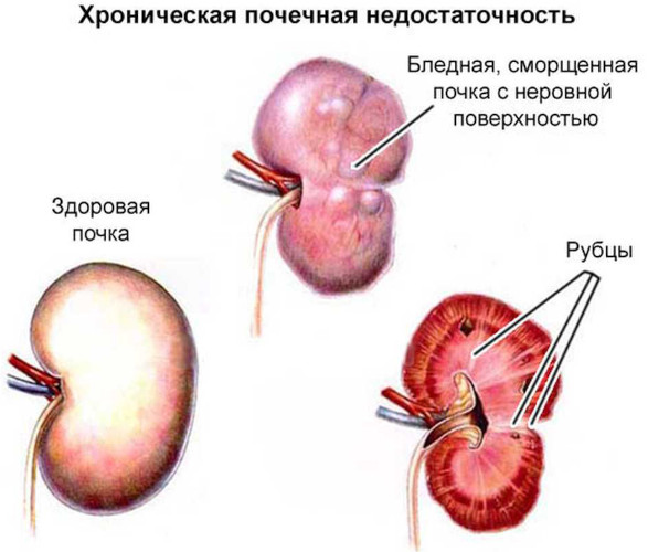 Хроническая почечная недостаточность. Симптомы, лечение, стадии