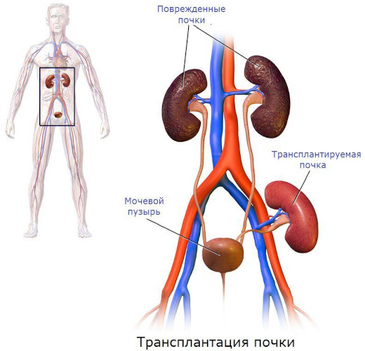 Хроническая почечная недостаточность. Симптомы, лечение, стадии