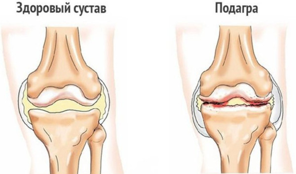 Индапамид или Гипотиазид. Что лучше принимать, отзывы