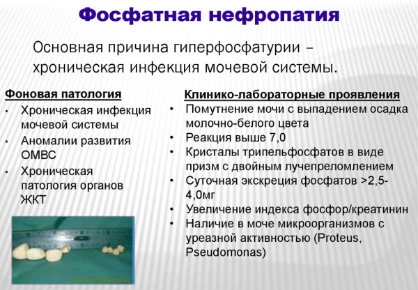 Нефропатия почек. Что это такое, симптомы и лечение у детей