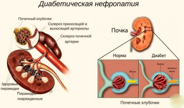 Нефропатия почек. Что это такое, симптомы и лечение у детей