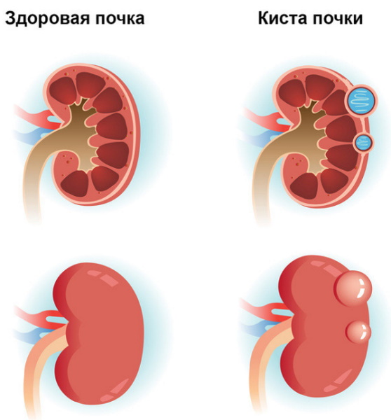 Поликистоз почек на УЗИ. Что это, симптомы и лечение