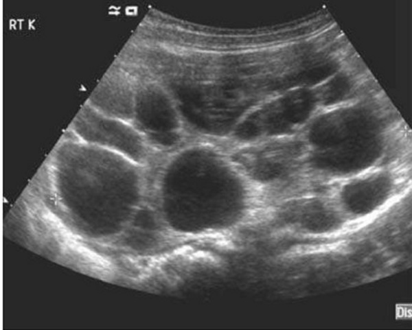 Поликистоз почек на УЗИ. Что это, симптомы и лечение