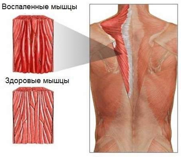 Полимиозит. Что это, симптомы и лечение, диагностика