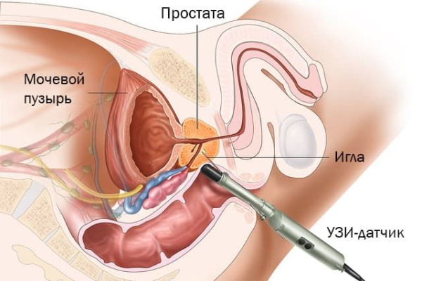 Простата. Анатомия, строение, МРТ, УЗИ