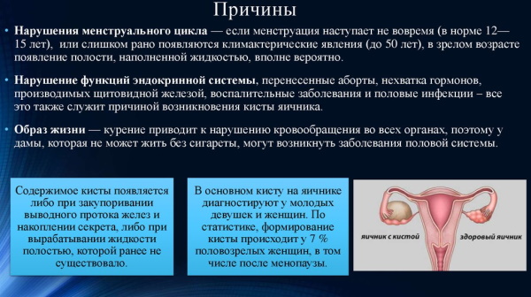 Ретенционное образование правого, левого яичника: что это такое