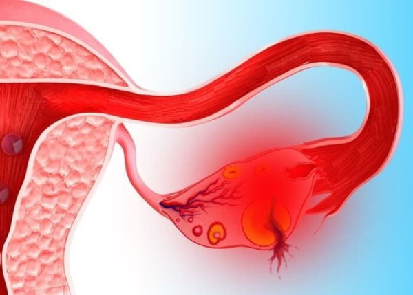 Ретенционное образование правого, левого яичника: что это такое