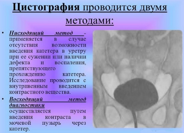 Цистография мочевого пузыря. Что это такое, как делают