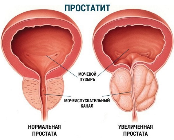 Цистография мочевого пузыря. Что это такое, как делают