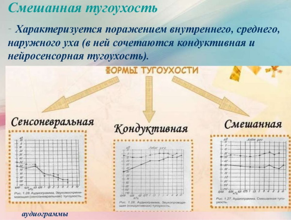 Тугоухость. Виды, лечение у взрослых 1-2-3-4 степени