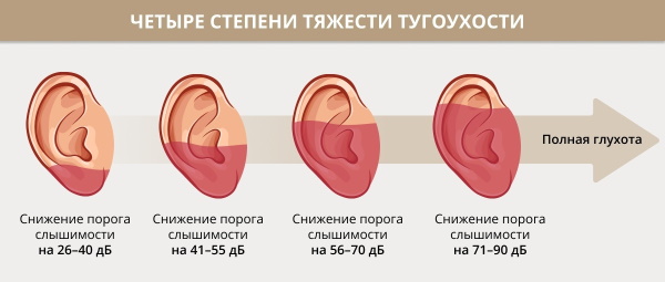 Тугоухость. Виды, лечение у взрослых 1-2-3-4 степени