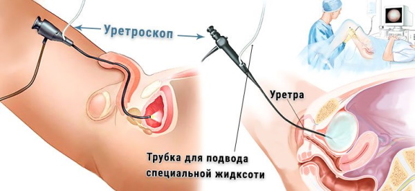 Уретроскопия. Что это у мужчин, женщин, больно ли, отзывы