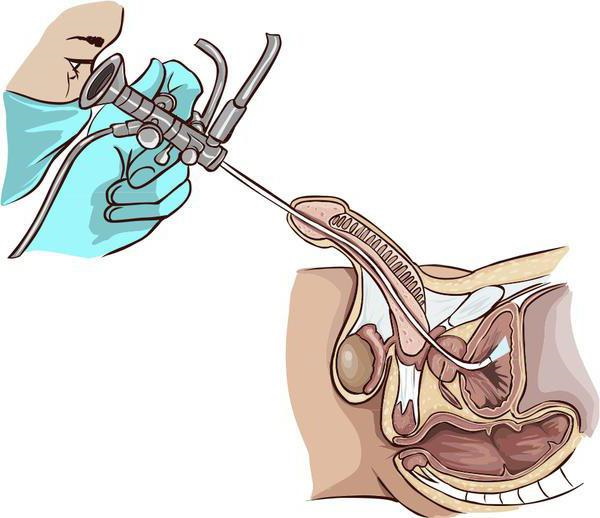 Уретроскопия. Что это у мужчин, женщин, больно ли, отзывы