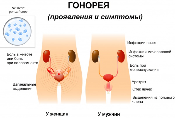 Урогенитальные инфекции. Что это такое, лечение, диагностика