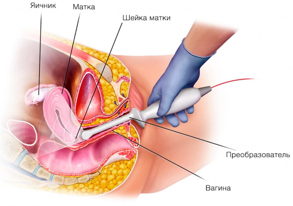 УЗИ яичников у женщин. Как проходит, что показывает
