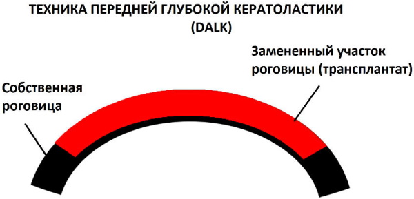 Заболевания роговицы глаза дистрофические. Лечение, рекомендации