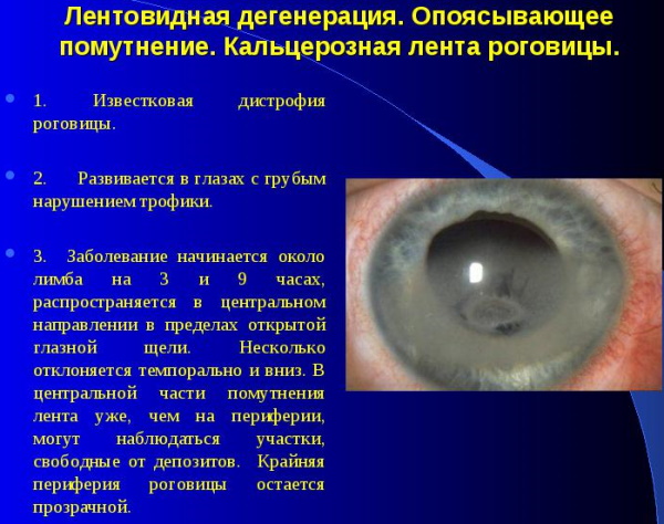 Заболевания роговицы глаза дистрофические. Лечение, рекомендации