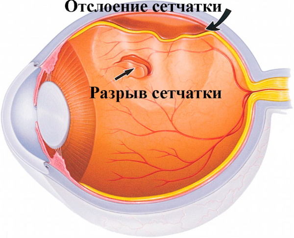 Заболевания сетчатки глаза. Список, какие бывают