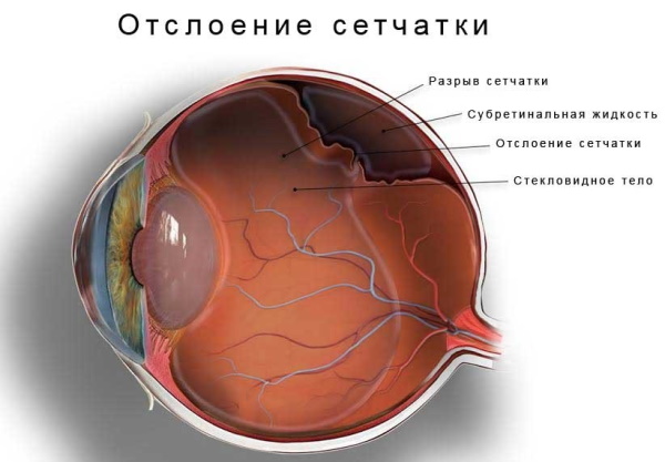 Заболевания сетчатки глаза. Список, какие бывают