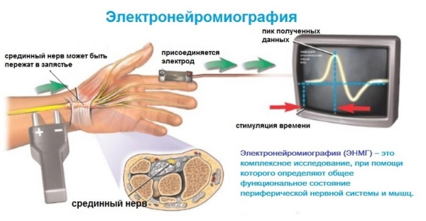 Дерматомиозит. Что это, диагностика, симптомы и лечение