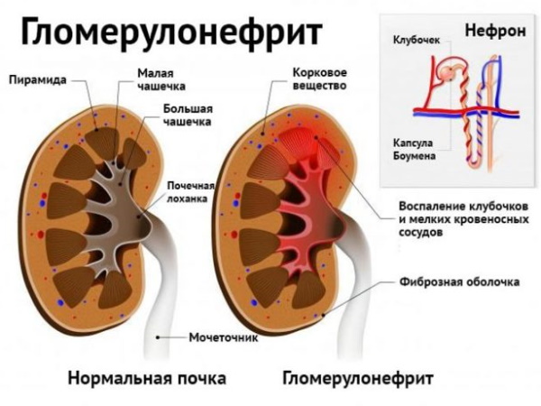 Диета 7а при гломерулонефрите почек остром, хроническом. Ограничение