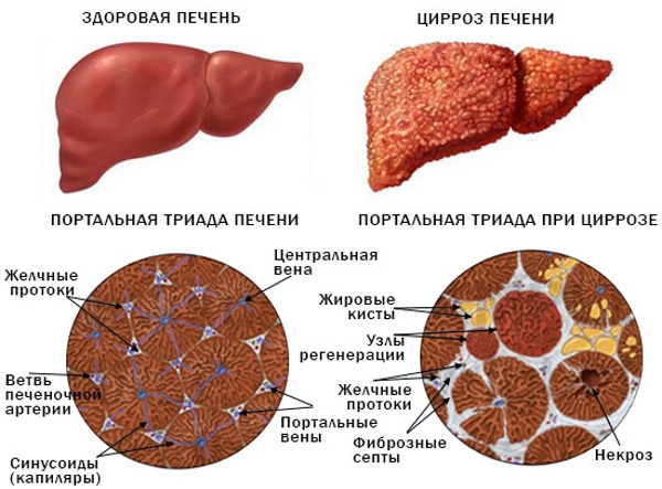 Эхогенность печени повышена. Что это значит у взрослого