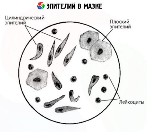 Эпителий в мазке у мужчин в большом количестве. Норма