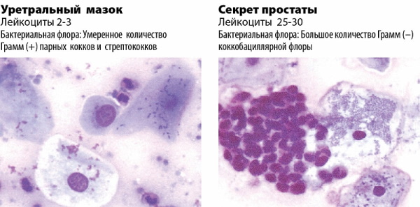 Эпителий в мазке у мужчин в большом количестве. Норма