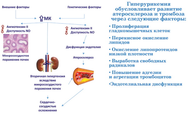 Гиперурикемия. Что это такое, симптомы и лечение