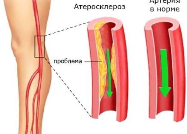 Дерматомиозит. Что это, диагностика, симптомы и лечение