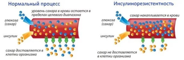 Гиперурикемия. Что это такое, симптомы и лечение