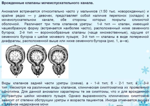 Инфравезикальная обструкция мочевого пузыря