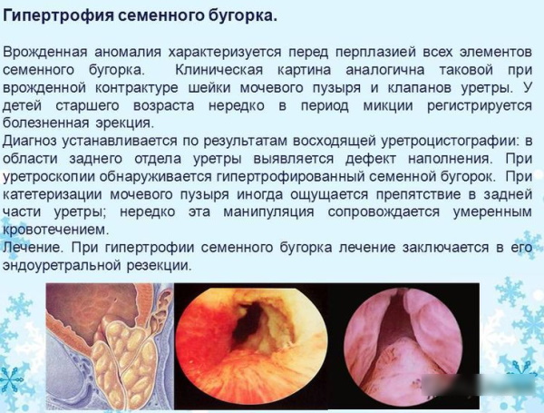 Инфравезикальная обструкция мочевого пузыря